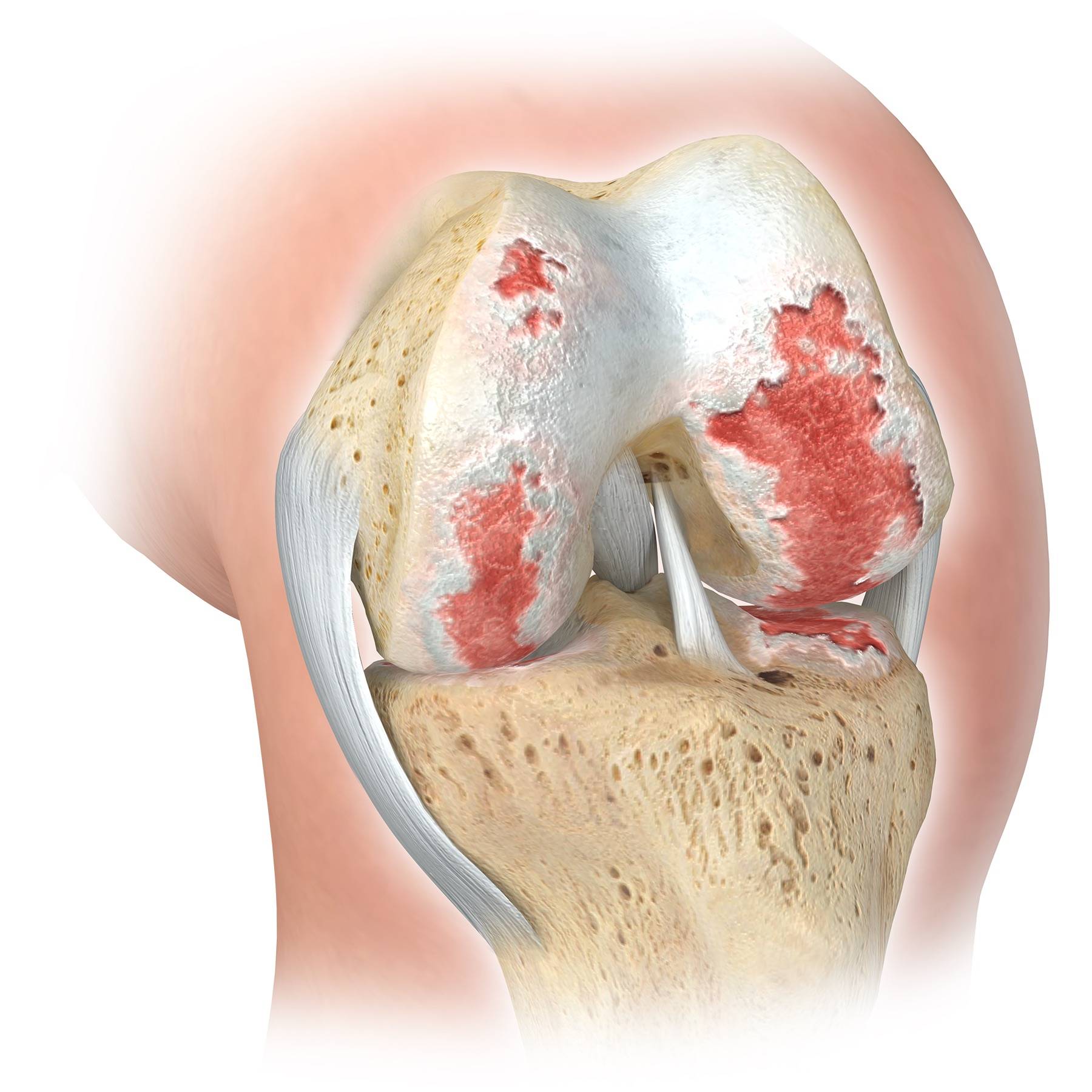 Nickel allergy knee replacement risk illustration with worn cartilage
