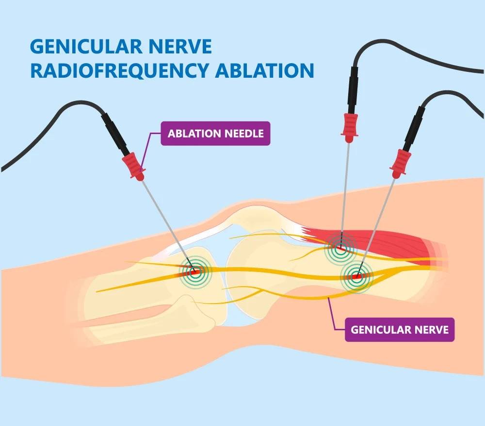 genicular nerve ablation diagram with ablation needle targeting nerves around knee