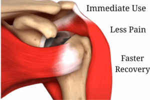 Muscle Sparing Shoulder Replacement