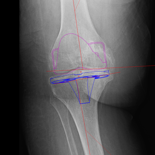Knee x ray template